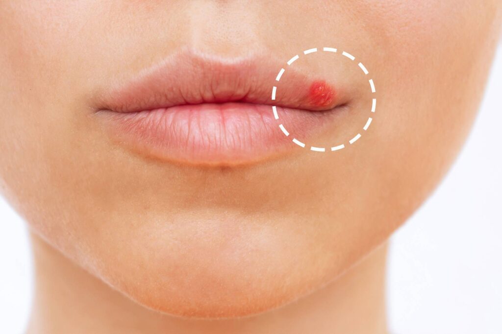 hpv on lips